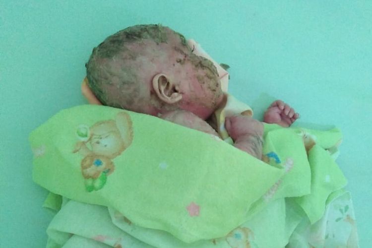 Mizyan Haziq Abdillah, bayi berusia 6 bulan dari wilayah perbatasan Kabupaten Nunukan ini menderita penyakit, kulitnya mengeras seperti plastik kemudian pecah dan mengelupas (Foto: kompas.com)

