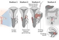 Ilustrasi (Foto: Alodokter)